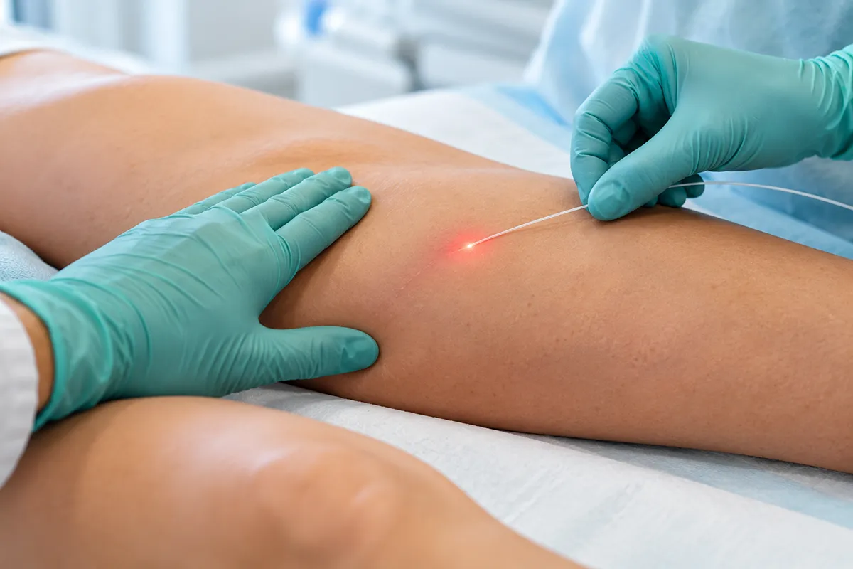 tratamento a laser da safena
